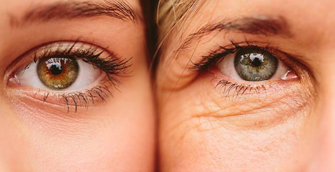 年齢の異なる2人の女性の目の周りの皮膚の老化の外部兆候